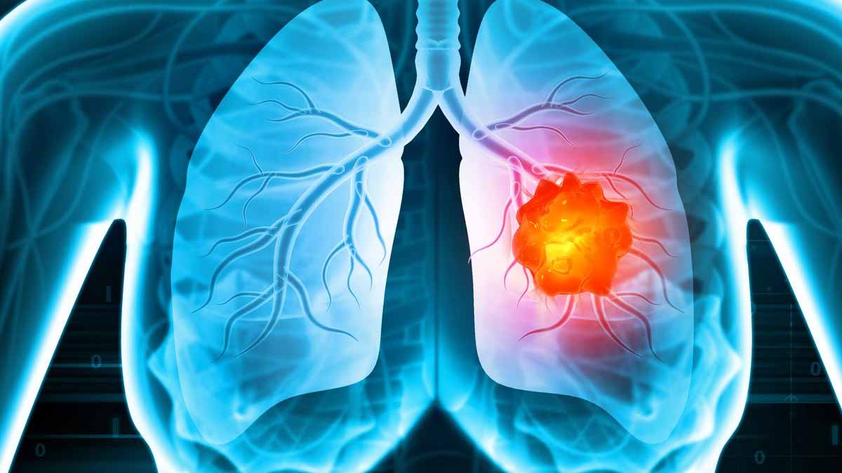 lung cancer treatment