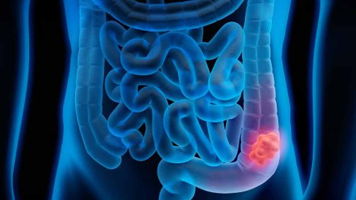 detecting cancer